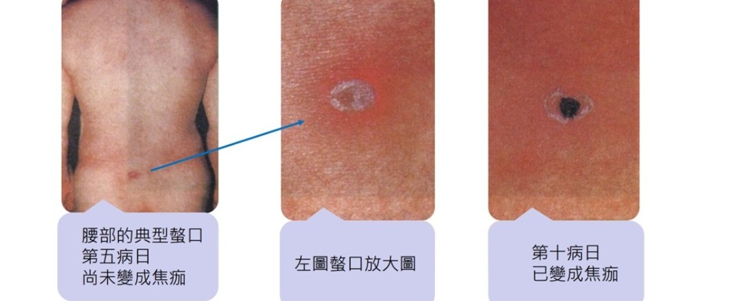 清明掃墓衛生局向民眾宣導恙蟲病防治